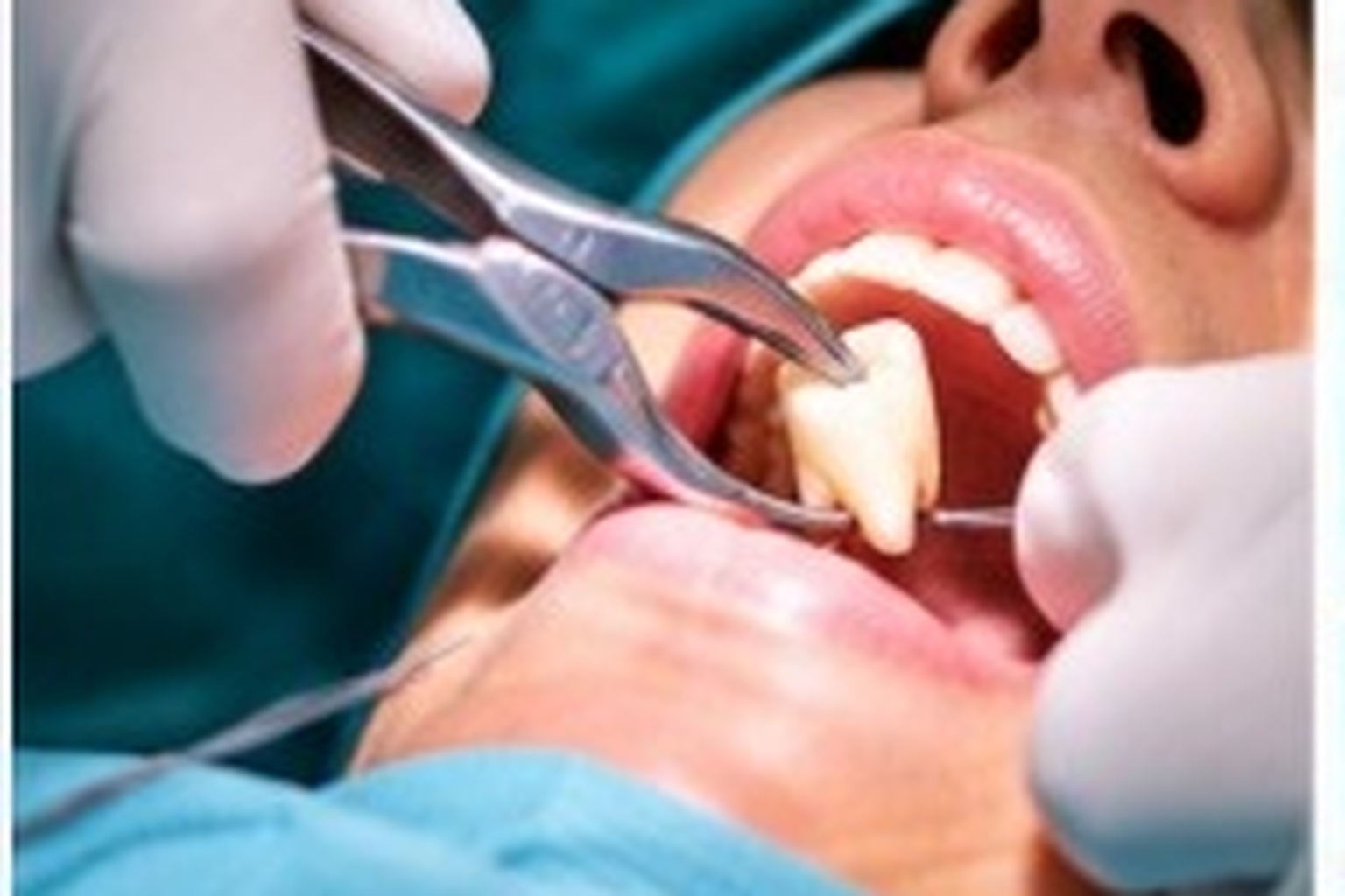 Fillings & Sealants