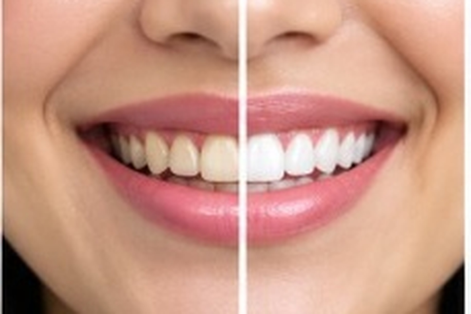 Teeth Cleaning