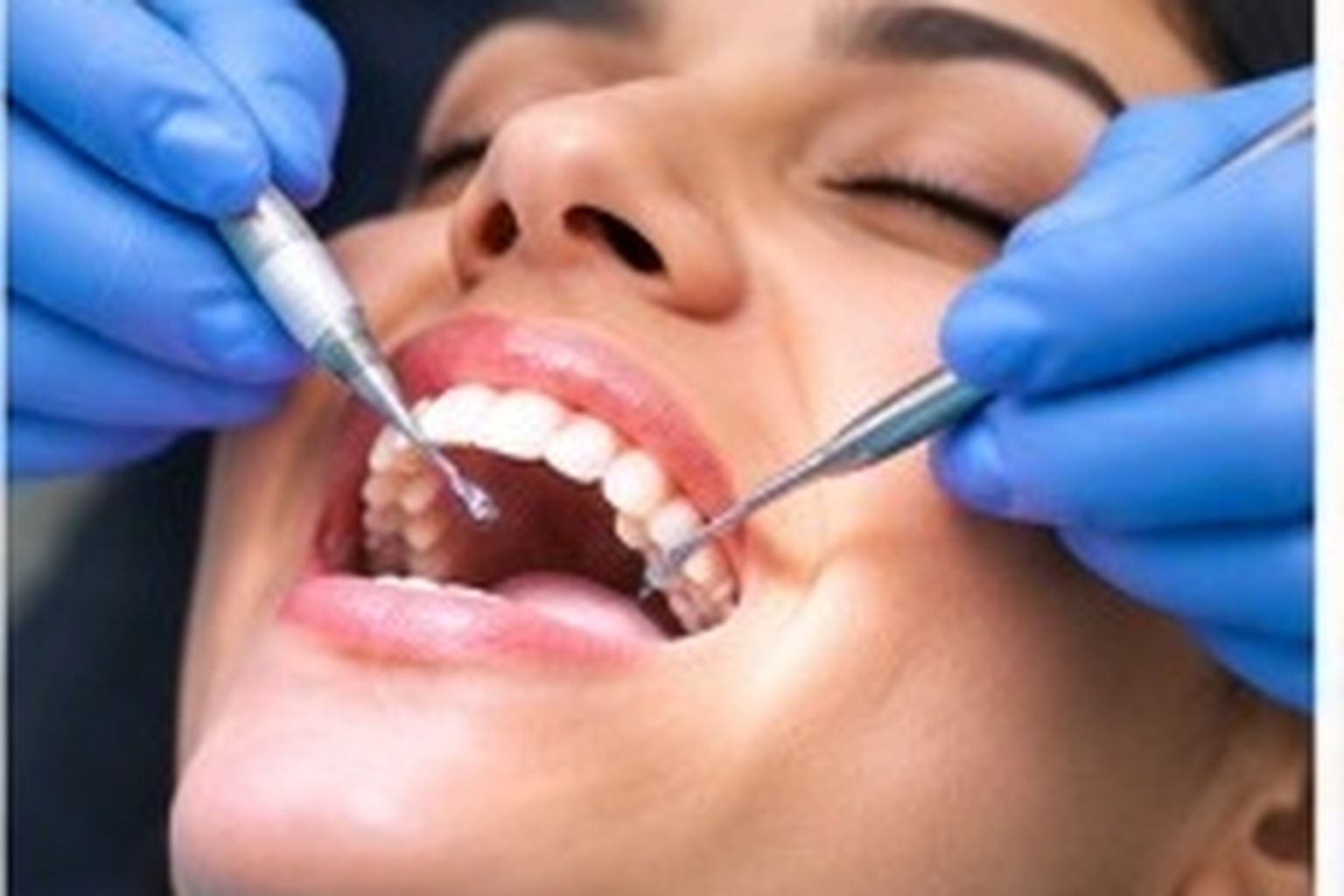 Teeth Cleaning